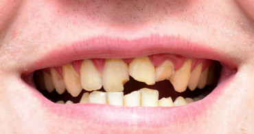 Bakımsız Dişler Bu Rahatsızlıklara Neden Oluyor!