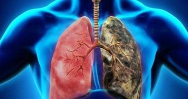 Erken Teşhis Hayat Kurtarır! Akciğer Kanserinin Belirtileri