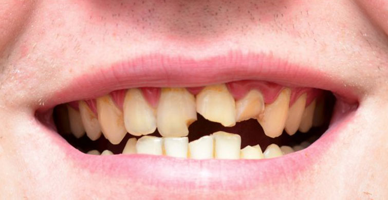 Bakımsız Dişler Bu Rahatsızlıklara Neden Oluyor!