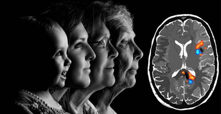 Alzheimer’ın İlk Belirtileri 20 Yıl Önce Başlıyor