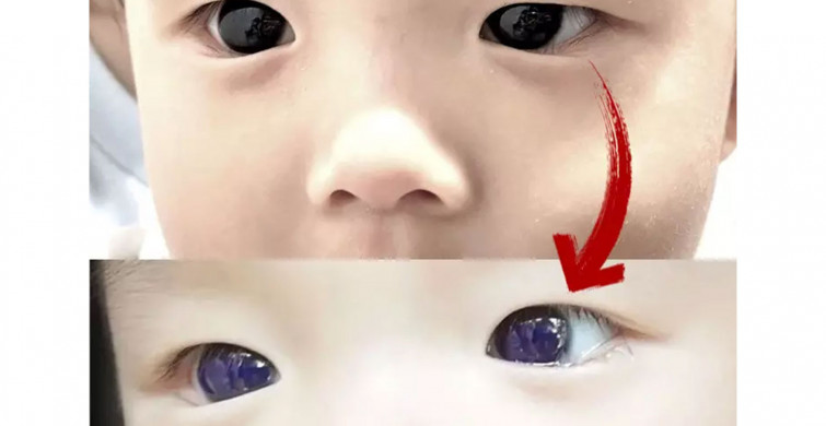 Bilim insanlarını korkutan olay: Küçük çocuğun kahverengi gözleri bir anda parlak maviye dönüştü, nedeni ise…
