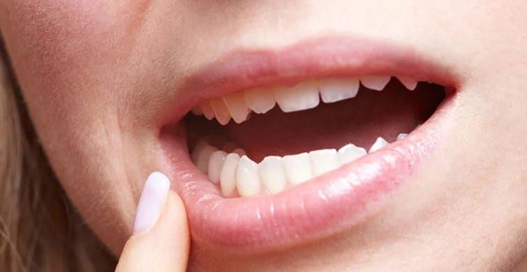 Diş Hastalığı Olanlar Koronavirüsü Daha Ağır Geçiriyor!