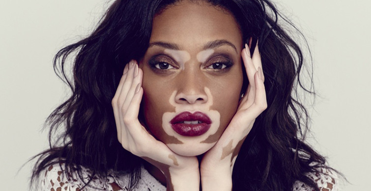 Winnie Harlow: Dünyadaki Tek Vitiligolu İnsan Olduğumu Düşündüm