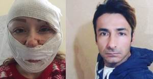 Boşanma Aşamasındaki Kocası Ukraynalı Kadının Yüzünü Parçaladı!