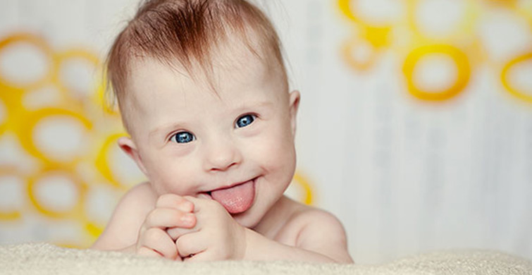 Yeni Doğan Bebeklerde Down Sendromu Belirtileri