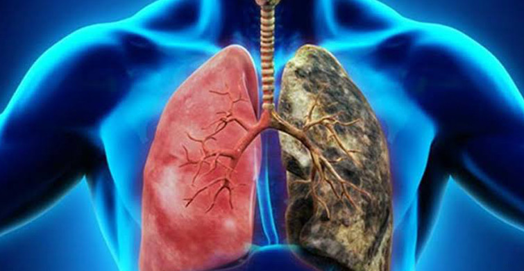 Erken Teşhis Hayat Kurtarır! Akciğer Kanserinin Belirtileri