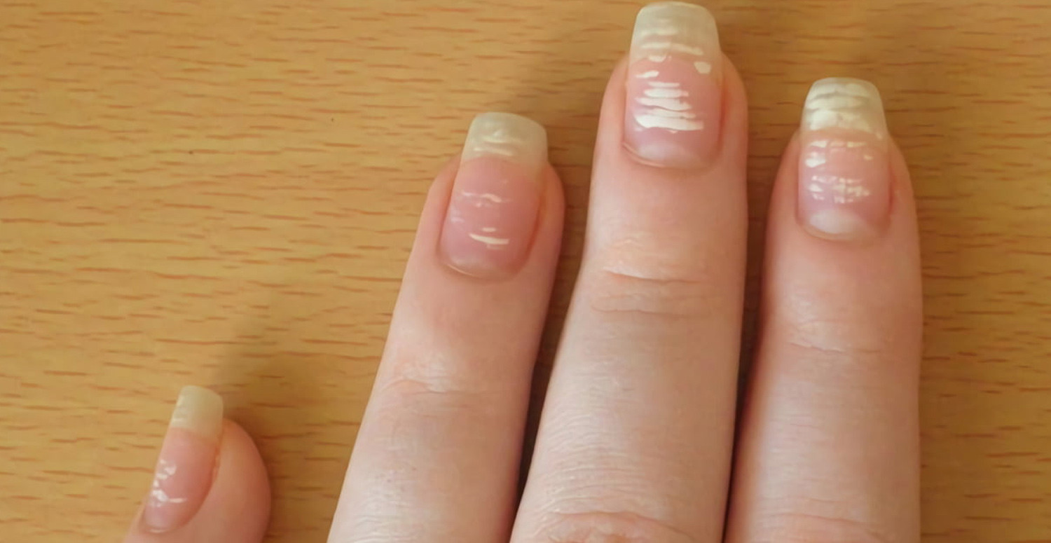 Полосы на ногтях что значит. Лейконихия белые пятна на ногтях. Лейконихия (белые пятнышки). Псориатическая лейконихия.