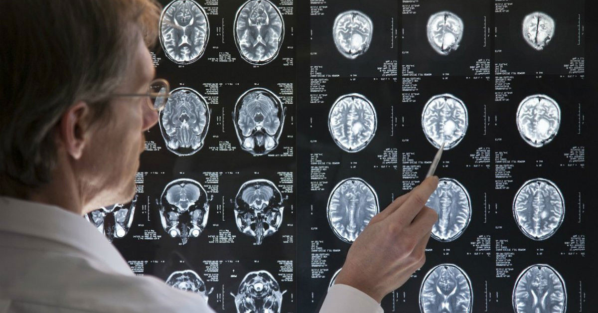 Beyin tümörü belirtileri nelerdir?