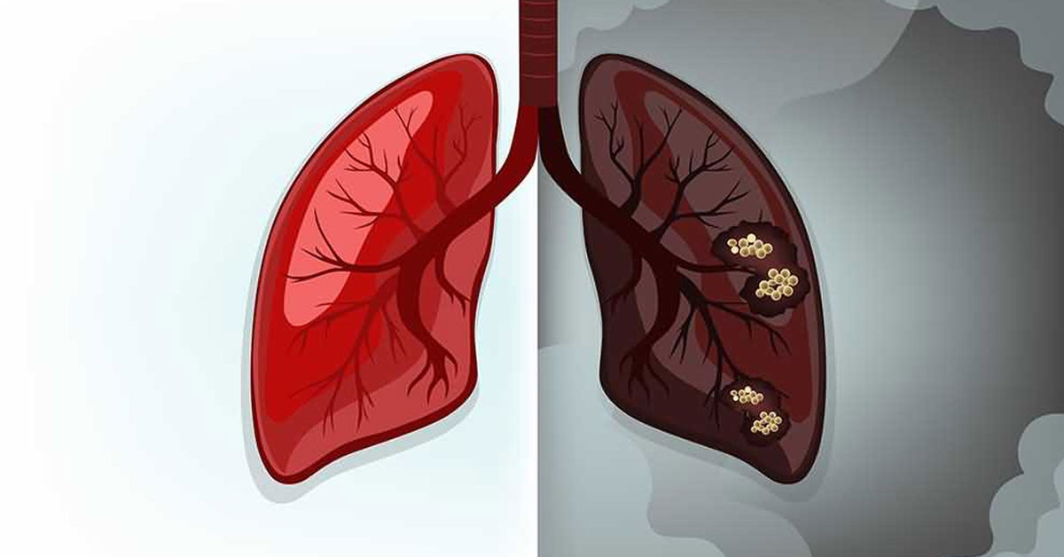 Akciğer kanserine sigaranın zararları