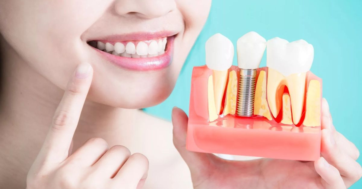 İmplant nedir? Diş implant tedavisi kimlere nasıl uygulanır?