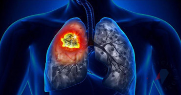 Akciğer kanseri son evre ne demek? Son evre kanserde tedavi yöntemleri neler?