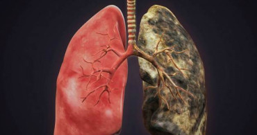Akciğer Kanserli Hasta Kaç Yıl Yaşar?