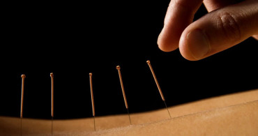 Akupunktur İle Diyetsiz ve Sporsuz Zayıflamak Mümkün