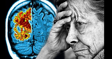 Alzheimer hastalığı artık tarihe karışıyor! Hastalara tünelin ucunda ışık göründü!