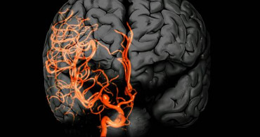 Beyin Anevrizmaları Belirtileri Nelerdir? Beyin Anevrizmaları Nedenleri Nelerdir? Beyin Anevrizmaları Nasıl Tedavi Edilir?