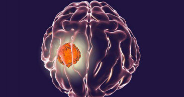 Beyin Kanseri Nedir? 