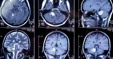Beyin Tümörü Çeşitleri ve Tedavi Yöntemleri