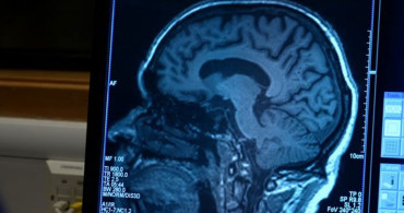 Bir Hastalığın Daha Çaresi Bulundu! Bilim insanları Alzheimer'ı Durdurmanın Yöntemini Açıkladı