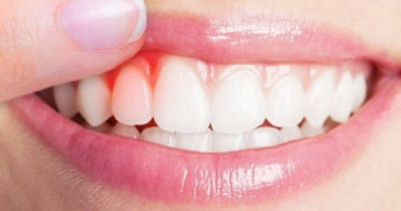 Diş Etinin Rengine Göre Ruj Tercihi Nasıl Yapılır?