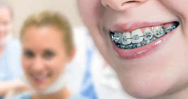 Diş Teli Takmanın Yaşı Var mı? Çocuklar Tel Takabilir mi?