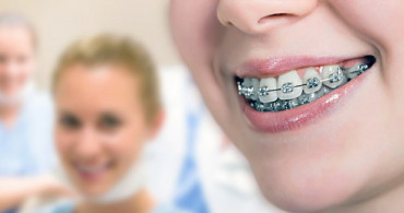 Diş Teli Tedavisinde Doğru Bilinen 7 Yanlış