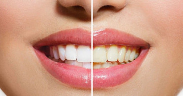 Dişlerde Kahverengi Lekeler Neden Oluşur? 