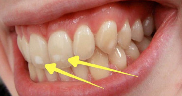 Dişlerdeki Beyaz Lekeleri Yok Eden Kür Tarifi