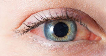 Göz Kızarıklığı ve Kaşıntı Koronavirüs Belirtisi midir?