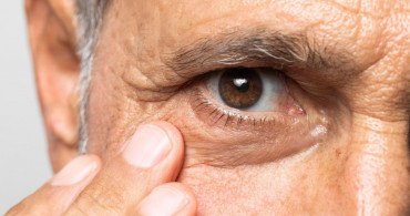 Göz tansiyonu nedir, neden olur, kaç olmalı? Şeker hastalığı göz tansiyonuna yol açıyor