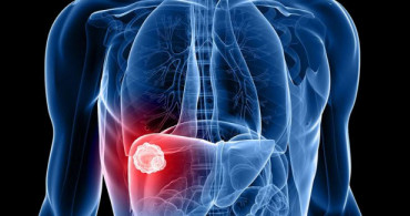 Karaciğer Kanserinden Korunmak İçin Ne Yapılabilir?