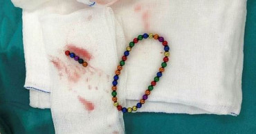 Karın Ağrısıyla Hastaneye Gitti: Midesinden 42 Adet Mıknatıs Topu Çıktı