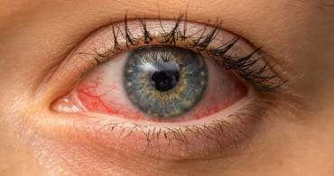 Kırmızı göz hastalığı olarak bilinen konjonktivit nedir, belirtileri nelerdir, nasıl tedavi edilir? Konjonktiva tümörleri ve çeşitleri