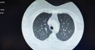 Koronavirüse Yakalanan Hastaların Ciğerlerindeki Görüntü Dehşete Düşürdü