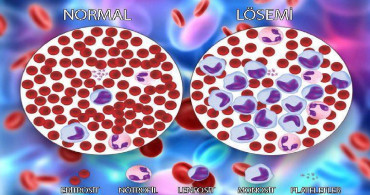 Lösemi nedir tedavisi nasıl olur? Löseminin belirtileri nelerdir? Kaç yaşlarında olur? Lösemi öldürür mü?