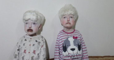 Mardinde Albino Kardeşler! Albino Nedir? Albino Belirtileri Nelerdir?