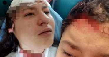Selfie Kurbanı: Kastamonu'da 14 Yaşındaki Kız Çocuğuna 5 Köpek Saldırdı!
