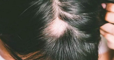 Will Smith’in karısının hastalığı Alopesi nedir? Alopecia sebepleri neler, neden olur, nasıl anlaşılır, tedavisi var mı?