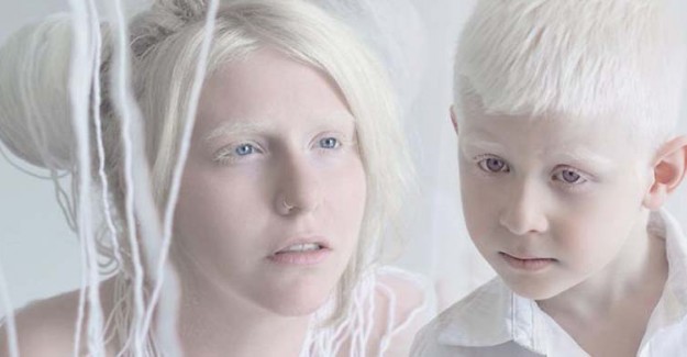 Albinizm Nedir? Kimlerde Görülür?