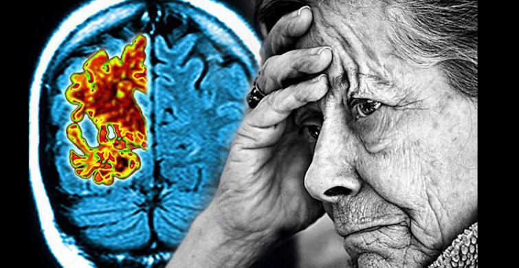 Alzheimer hastalığı artık tarihe karışıyor! Hastalara tünelin ucunda ışık göründü!