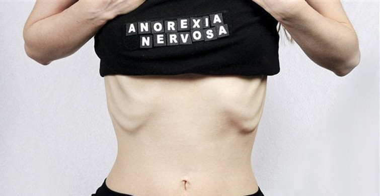 Anoreksiya Nervoza Nedir?