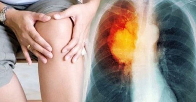 Bacaktan Gelen Tehlike: Akciğer Embolisi