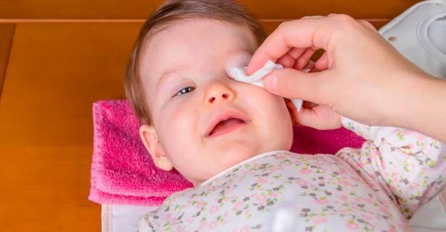 Bebeklerde Göz Çapaklanması Nasıl Giderilir?