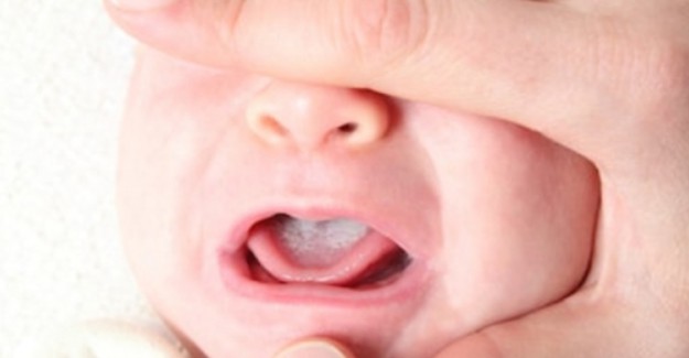 Bebeklerde Pamukçuk Neden Olur Ve Nasıl Tedavi Edilir?