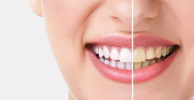Diş Beyazlatma Nedir? Nasıl Yapılır?