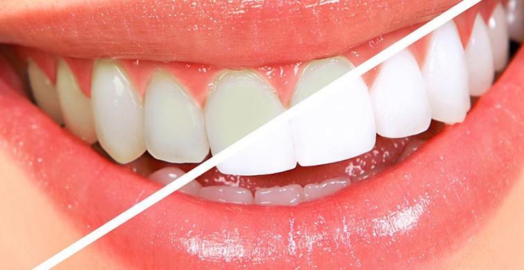 Diş Beyazlatmak Zararlı mı?