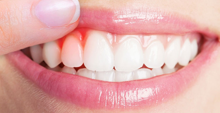 Diş Eti İltihabı Kovid-19'dan Ölme Riskini 9 Kat Artırıyor