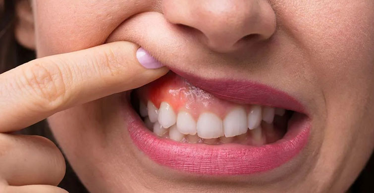 Diş Eti Rahatsızlığı Olanlara Koronavirüs Uyarısı!
