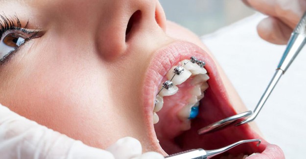 Diş Teli Takanlar Dişlerini Nasıl Fırçalamalı? Arayüz Fırçası Nedir?