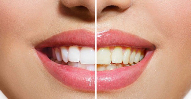 Dişlerde Kahverengi Lekeler Neden Oluşur? 