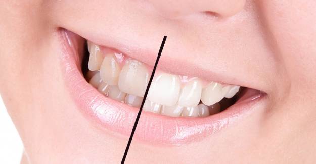 Dişlerin Beyazlaması İçin Öneriler 